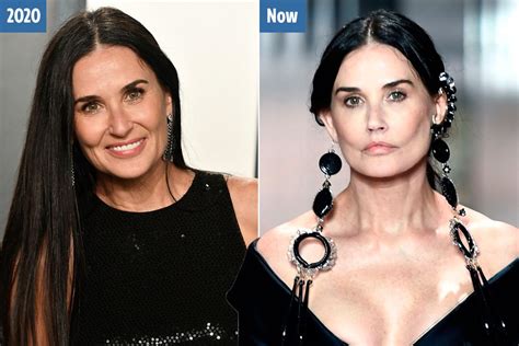demi moore face surgery